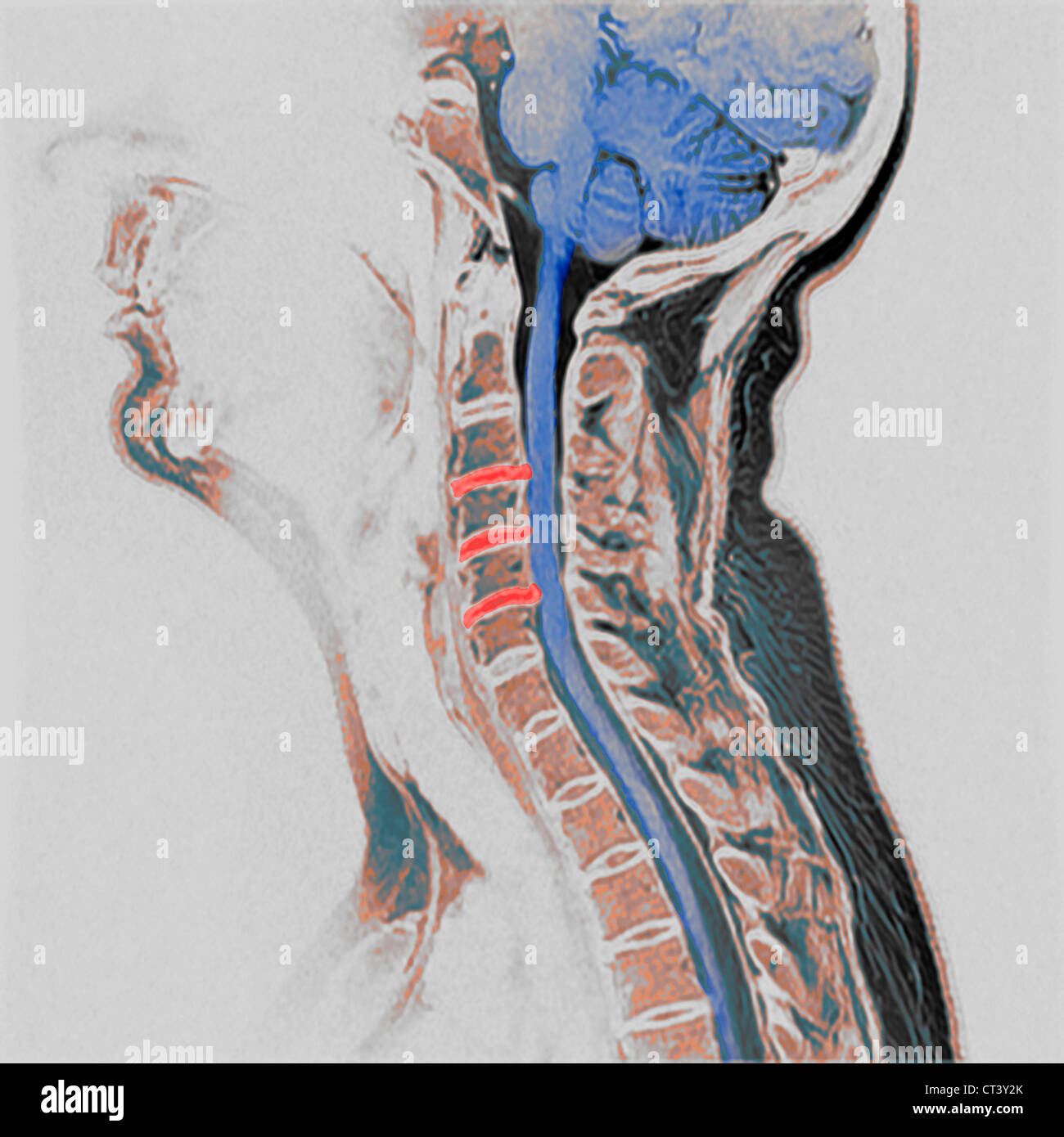 Artrosi cervicale, MRI Foto Stock