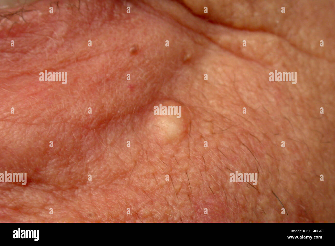 Sebaceous cysts immagini e fotografie stock ad alta risoluzione - Alamy