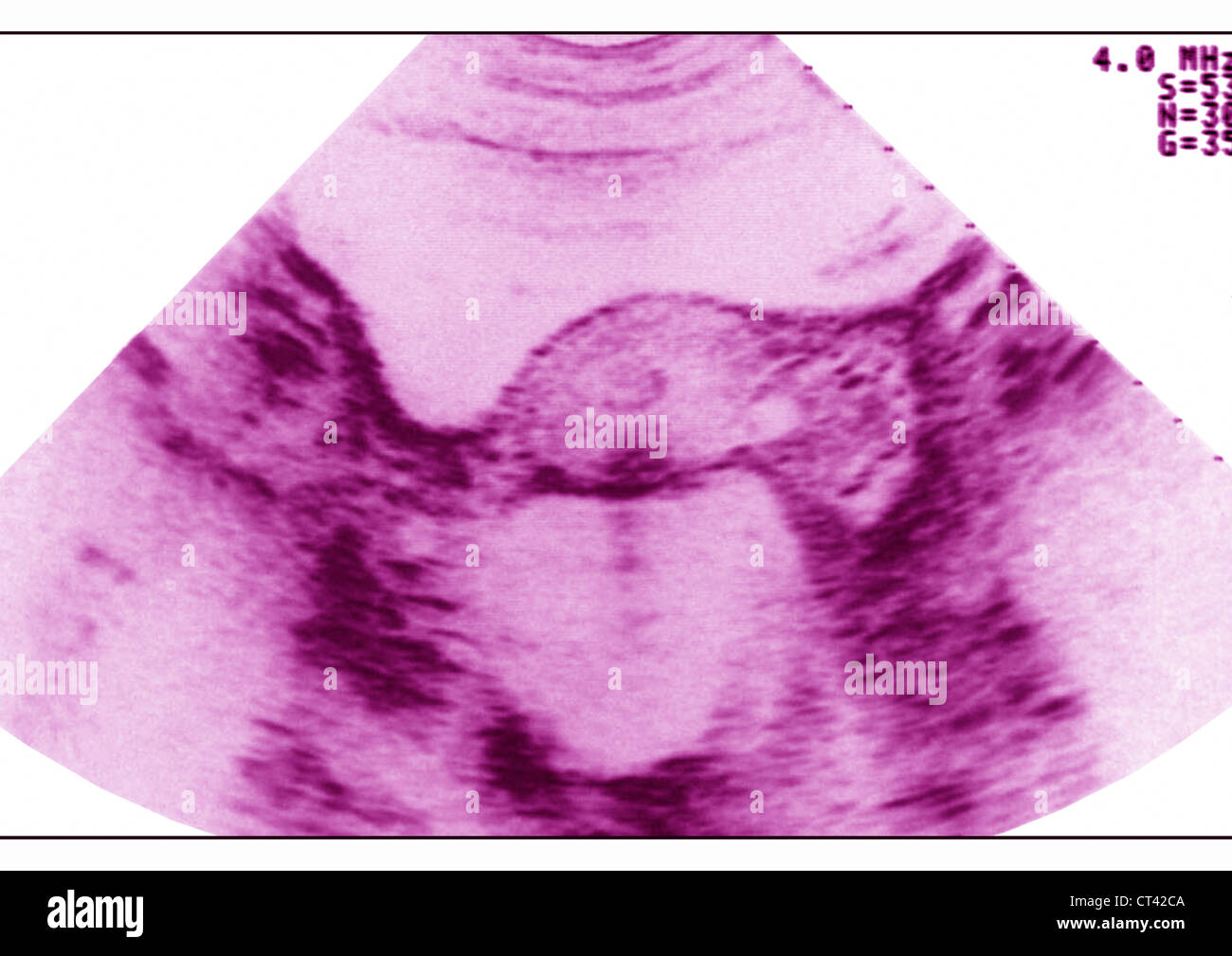 HYDROSALPINX, ecografia Foto Stock