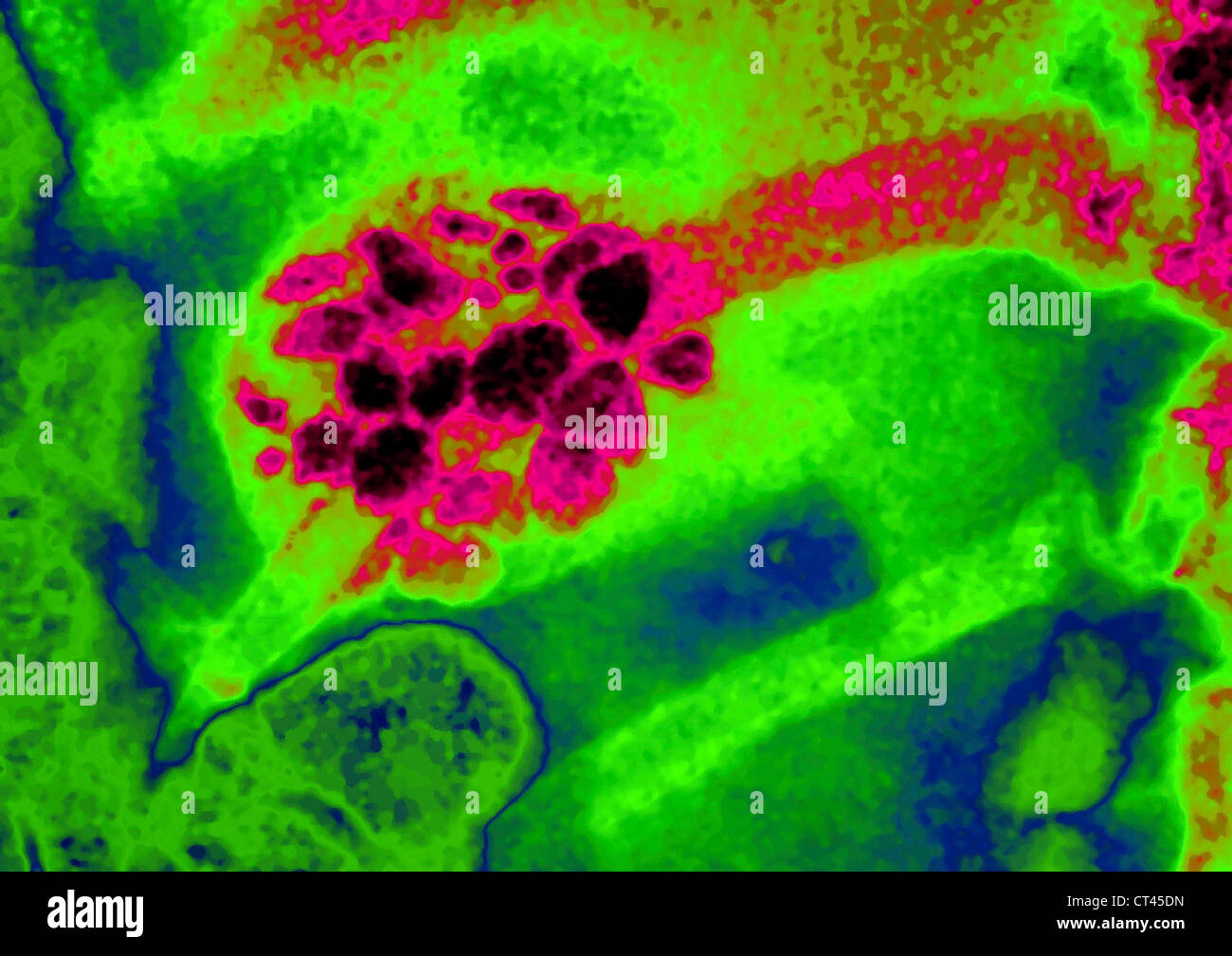 GALLSTONE, X-RAY Foto Stock