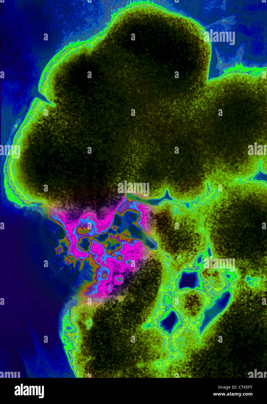 CARCINOMA CECAL, X-RAY Foto Stock