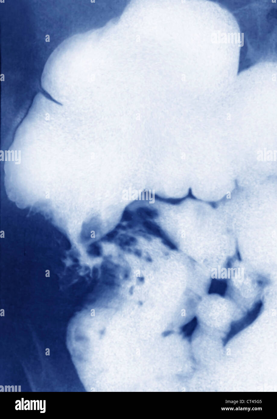 CARCINOMA CECAL, X-RAY Foto Stock