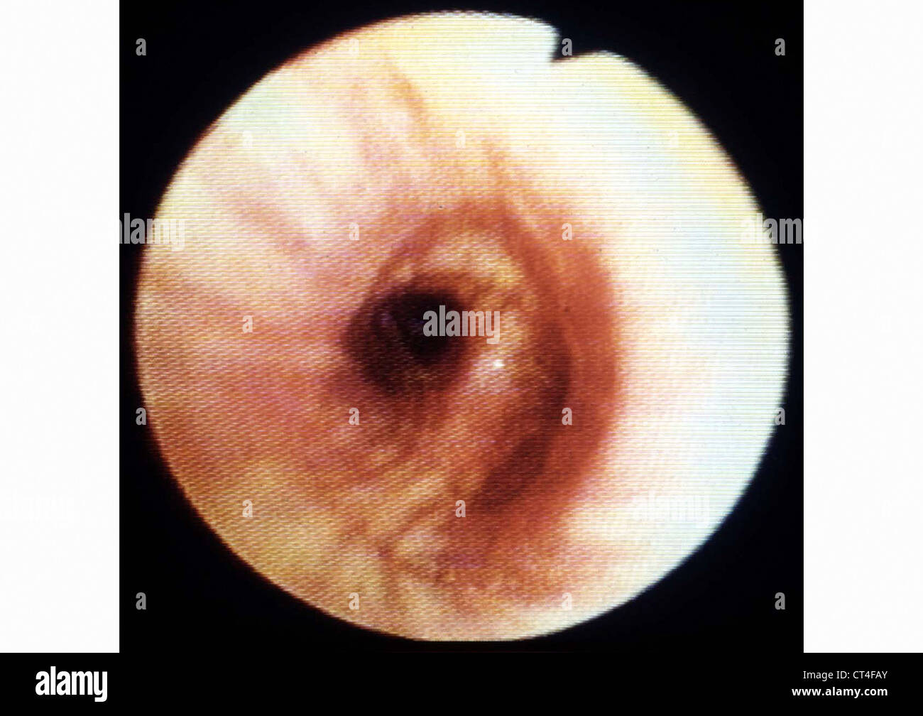 Cancro bronchiale, endoscopia Foto Stock