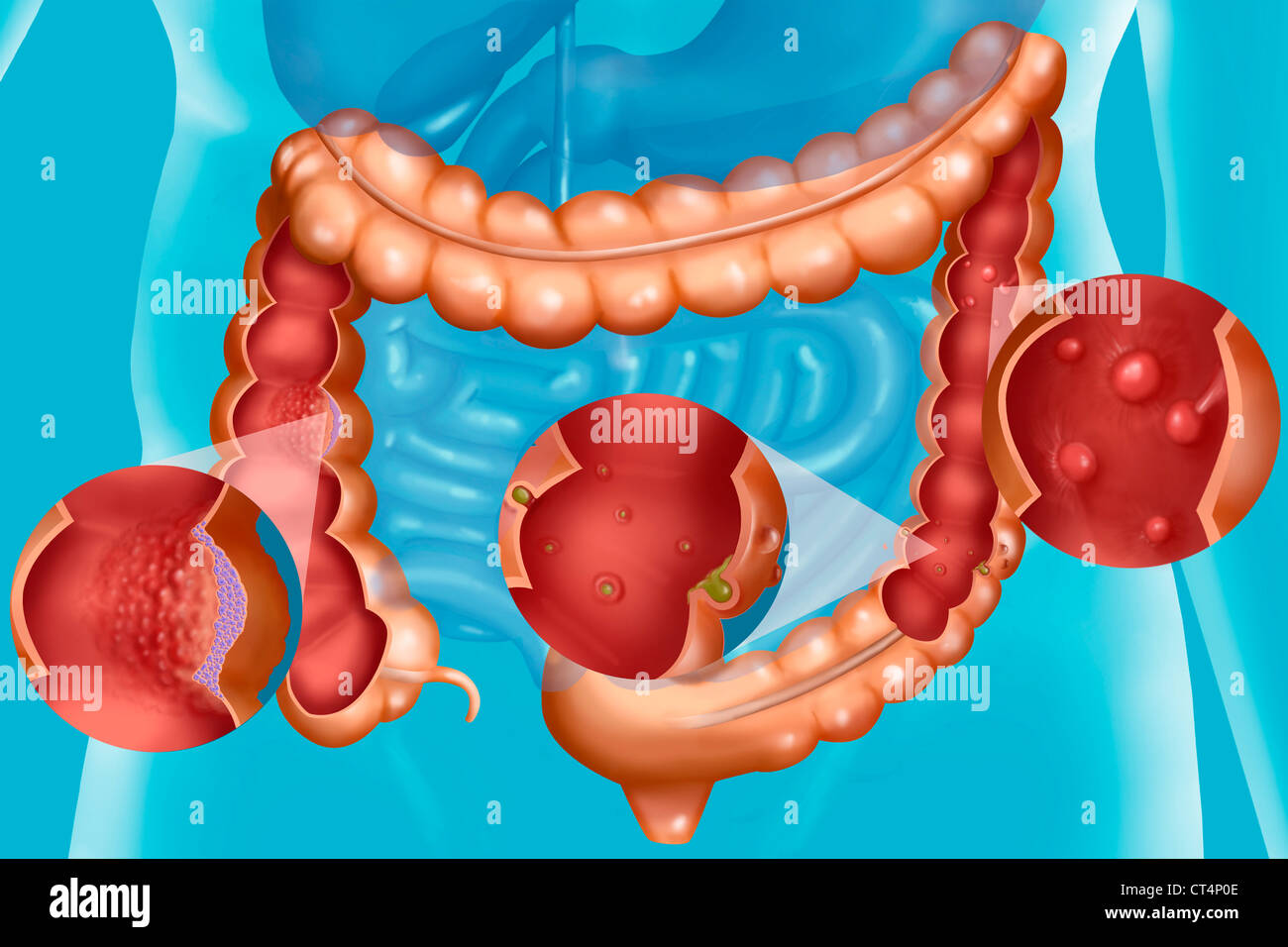 Malattia del colon, illustrazione Foto Stock