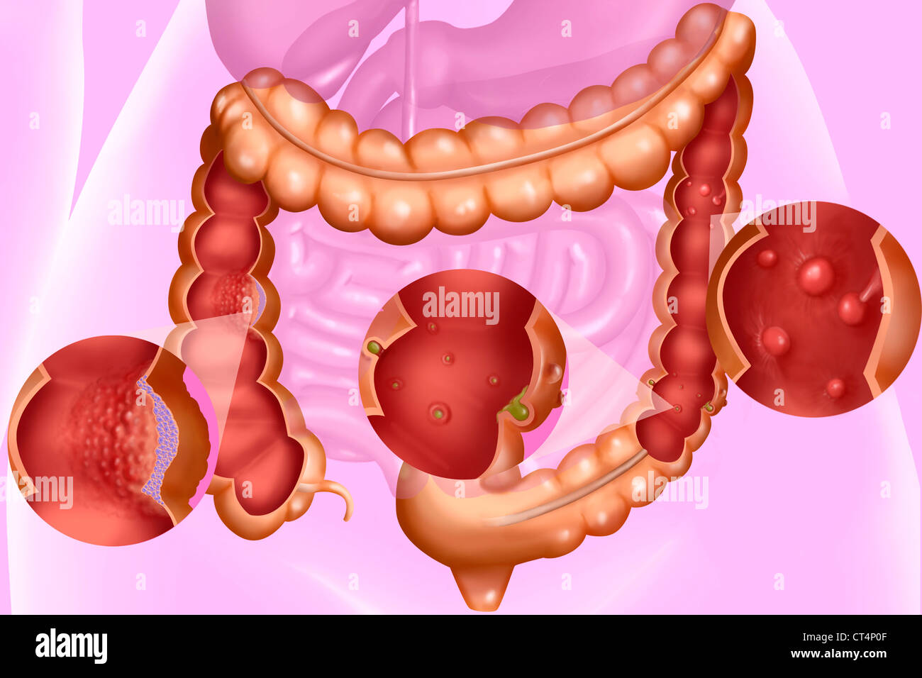 Malattia del colon, illustrazione Foto Stock