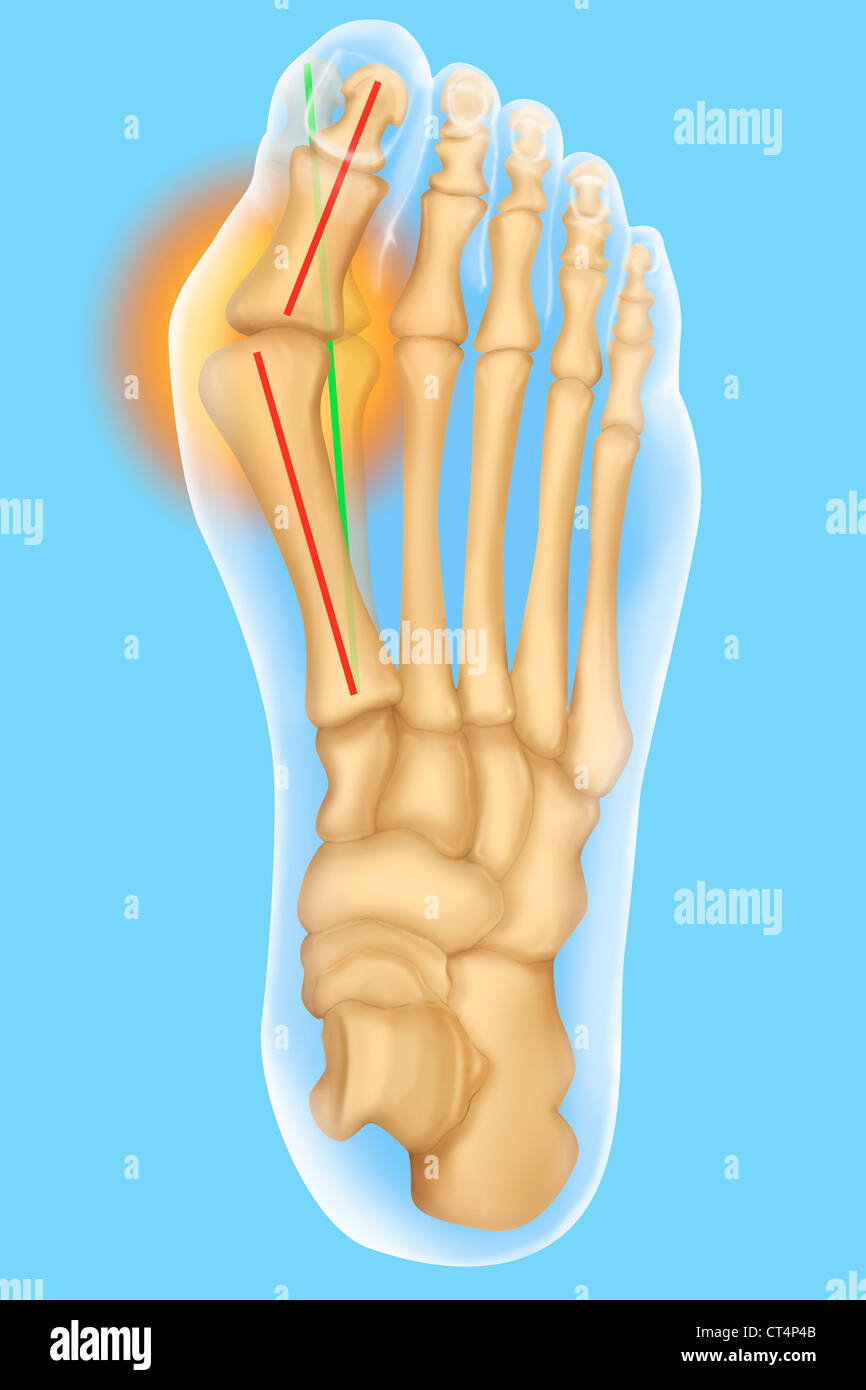 Alluce valgo, illustrazione Foto Stock