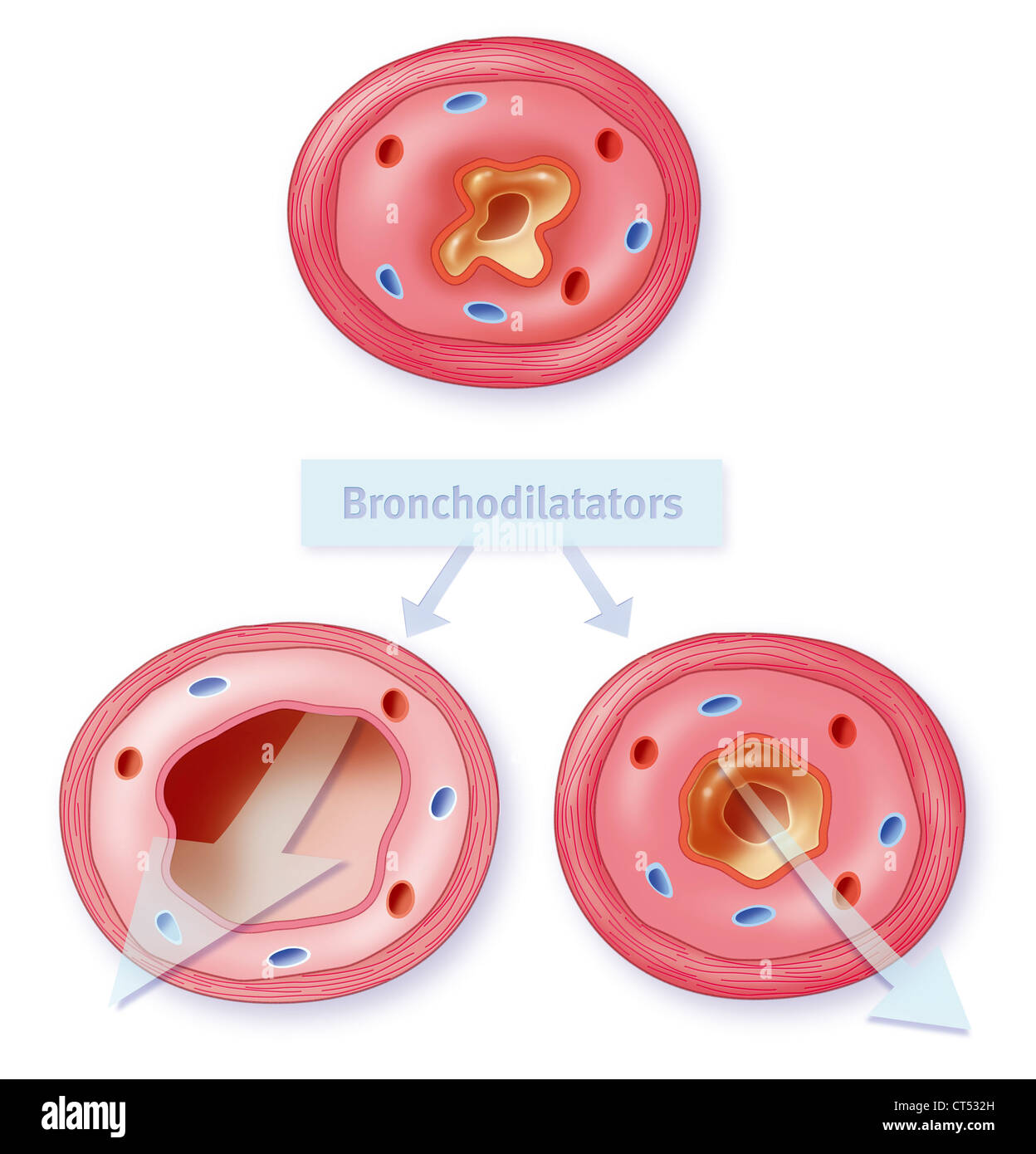 BRONCHOPNEUMOPATHY, disegno Foto Stock