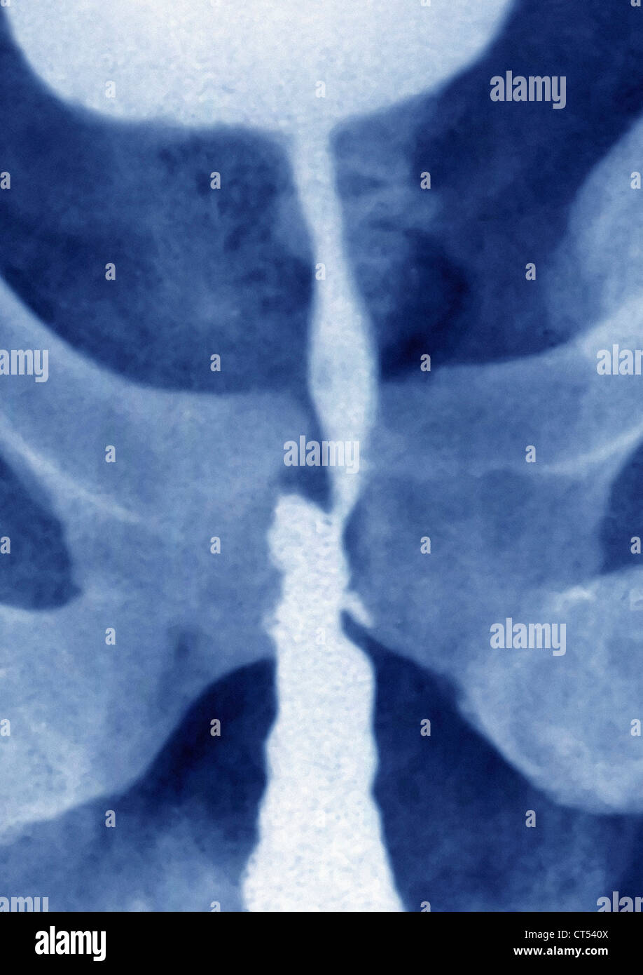 Stenosi uretrale, X-RAY Foto Stock
