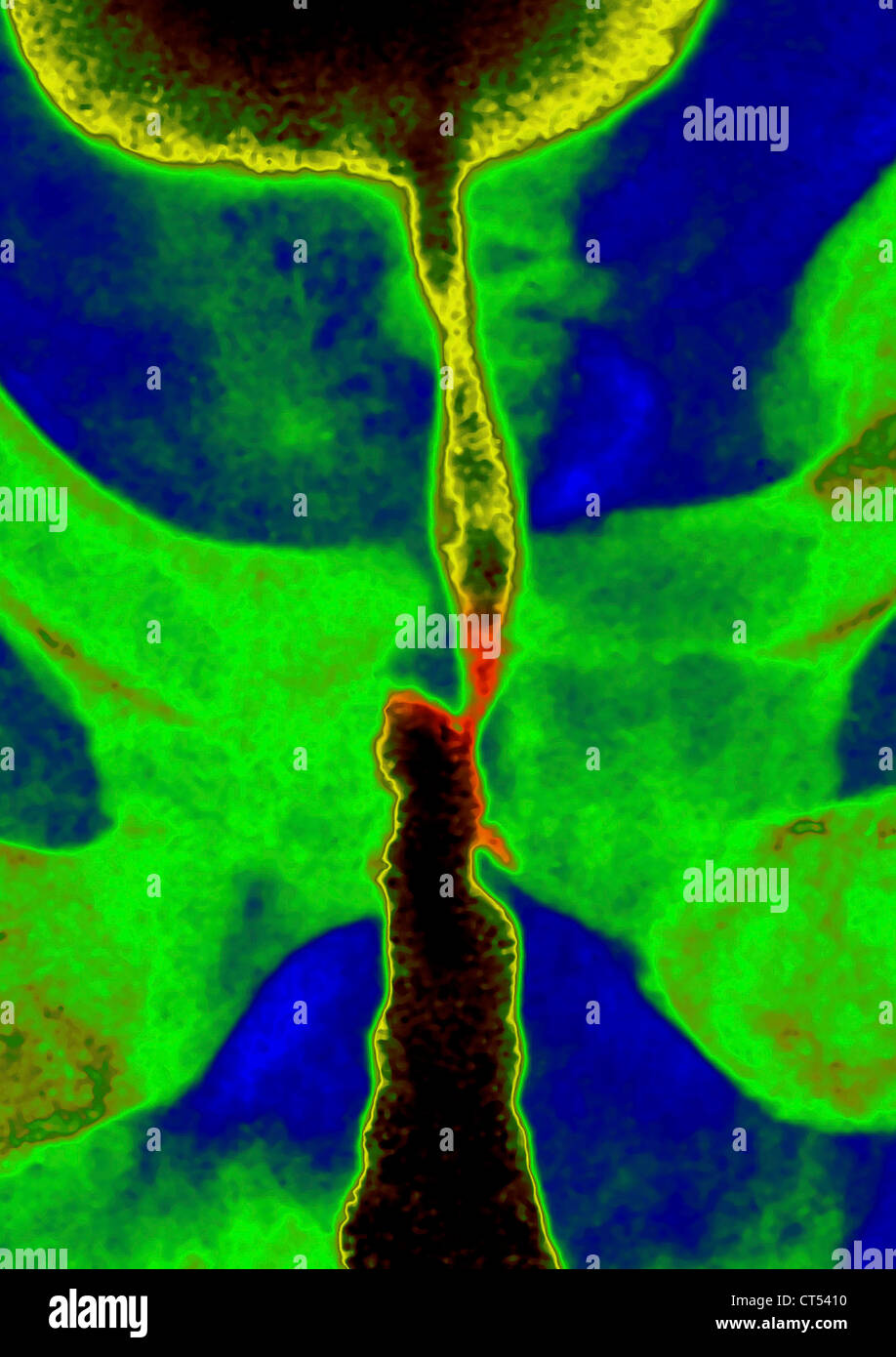 Stenosi uretrale, X-RAY Foto Stock