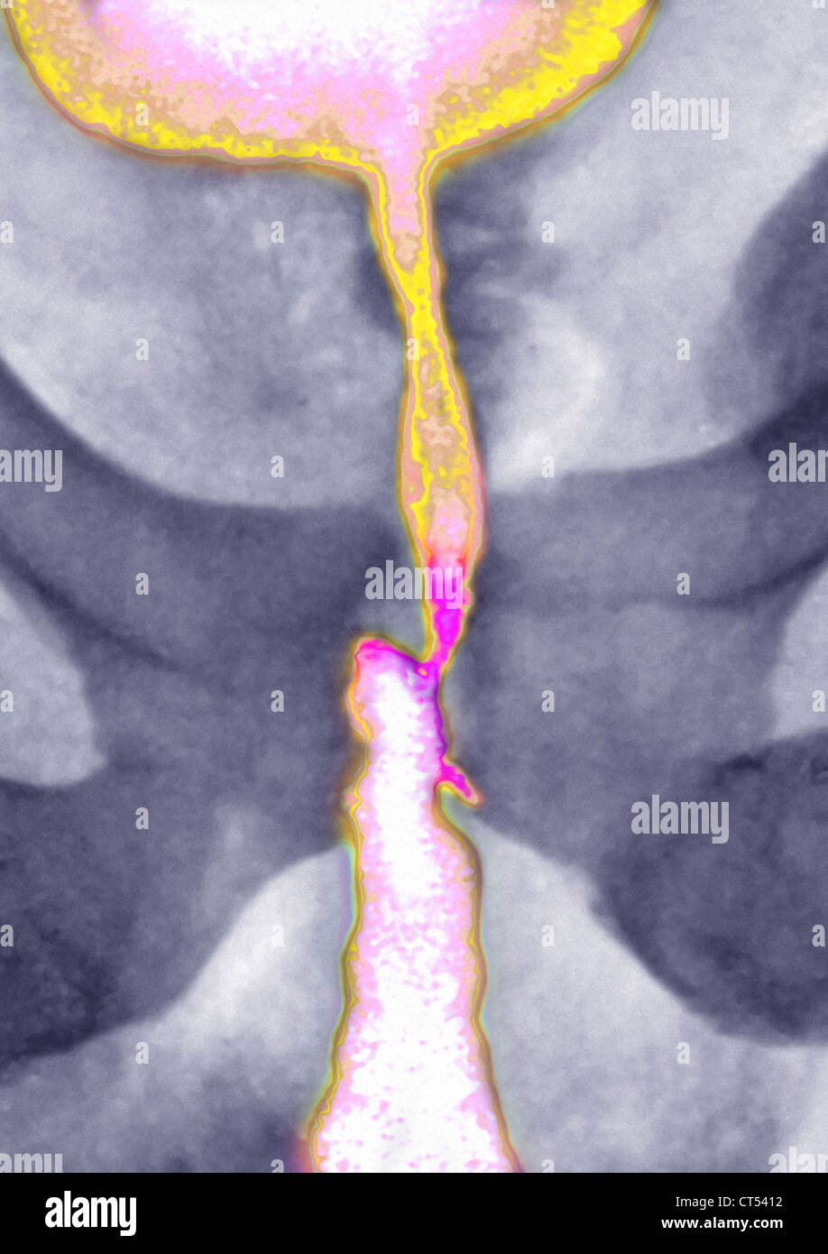 Stenosi uretrale, X-RAY Foto Stock