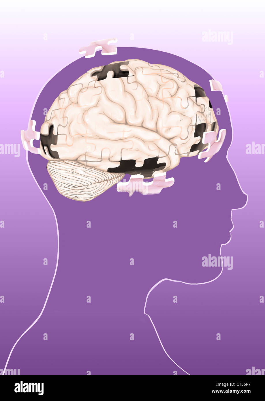 Il MORBO DI ALZHEIMER, disegno Foto Stock