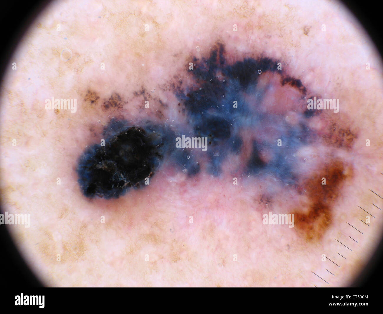 Il melanoma maligno Foto Stock