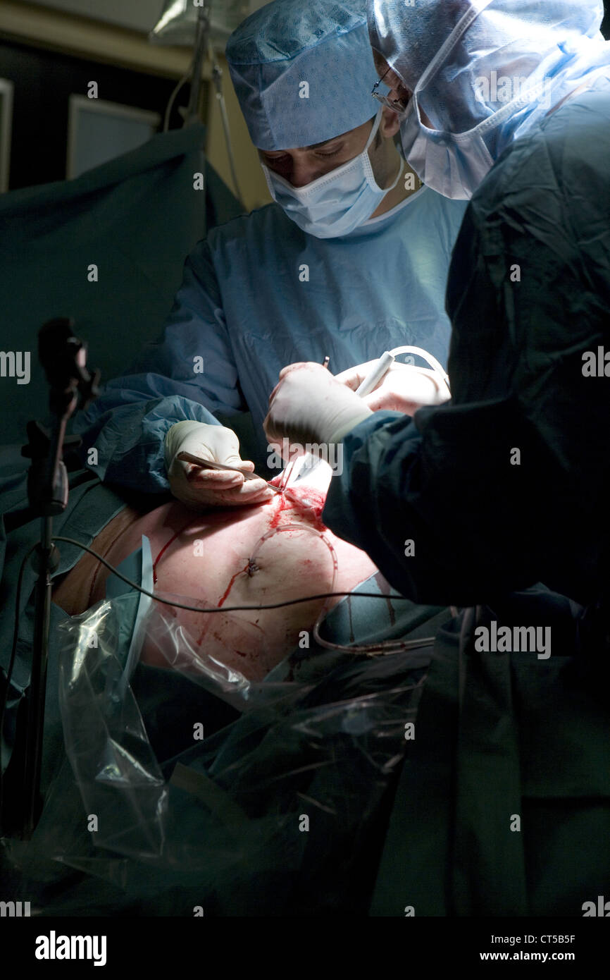CHIRURGIA DELL'OBESITÀ Foto Stock