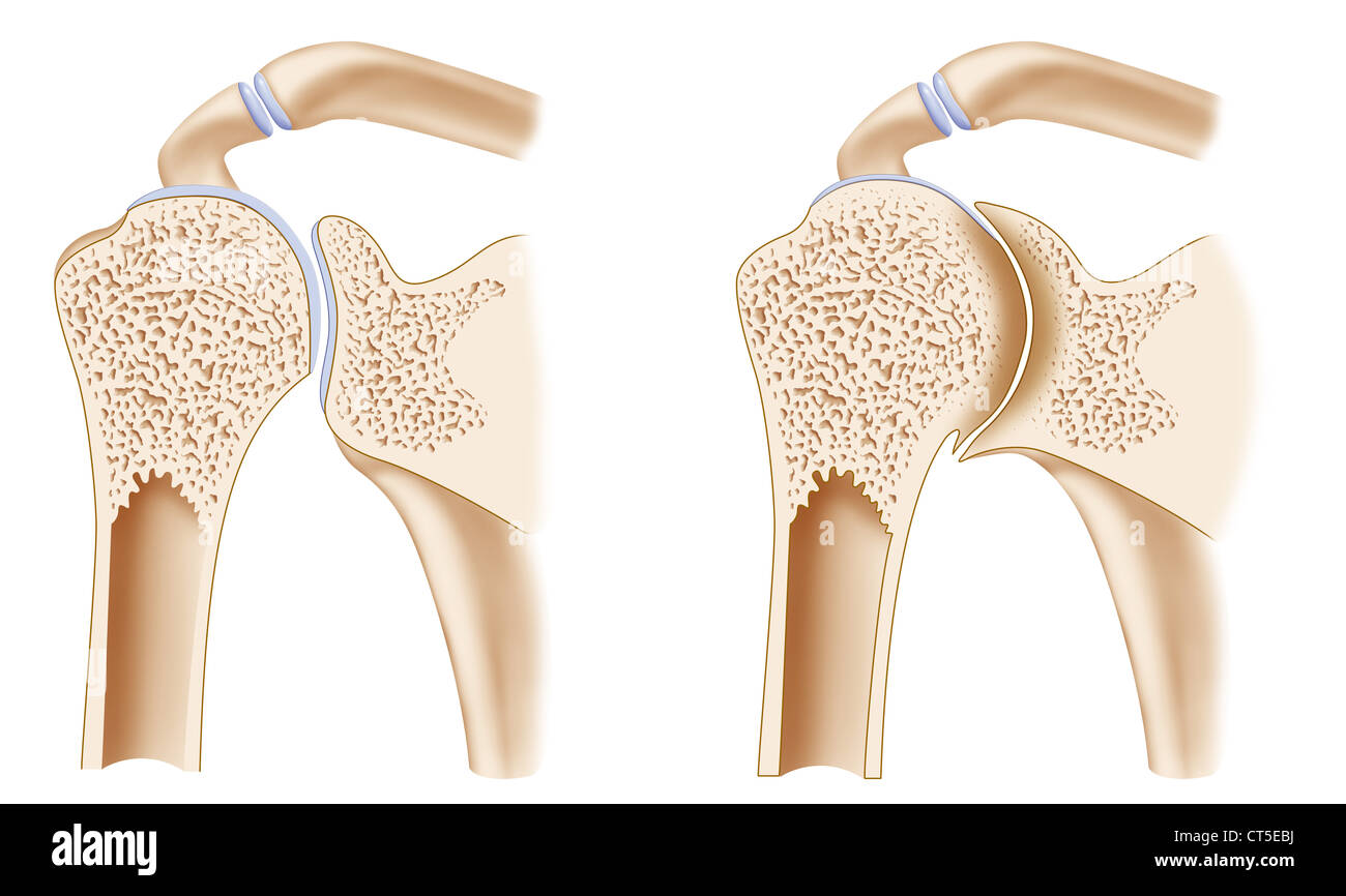 HEMOPHILIC ARTHOPATHY Foto Stock