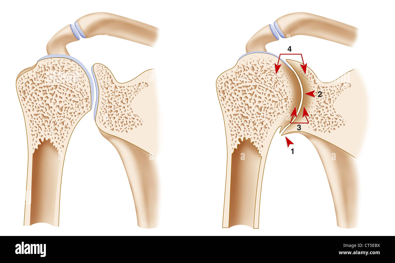 HEMOPHILIC ARTHOPATHY Foto Stock