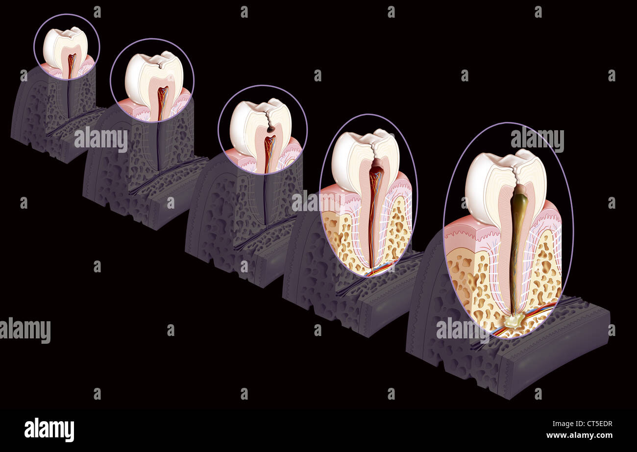 CARIE dentali, disegno Foto Stock