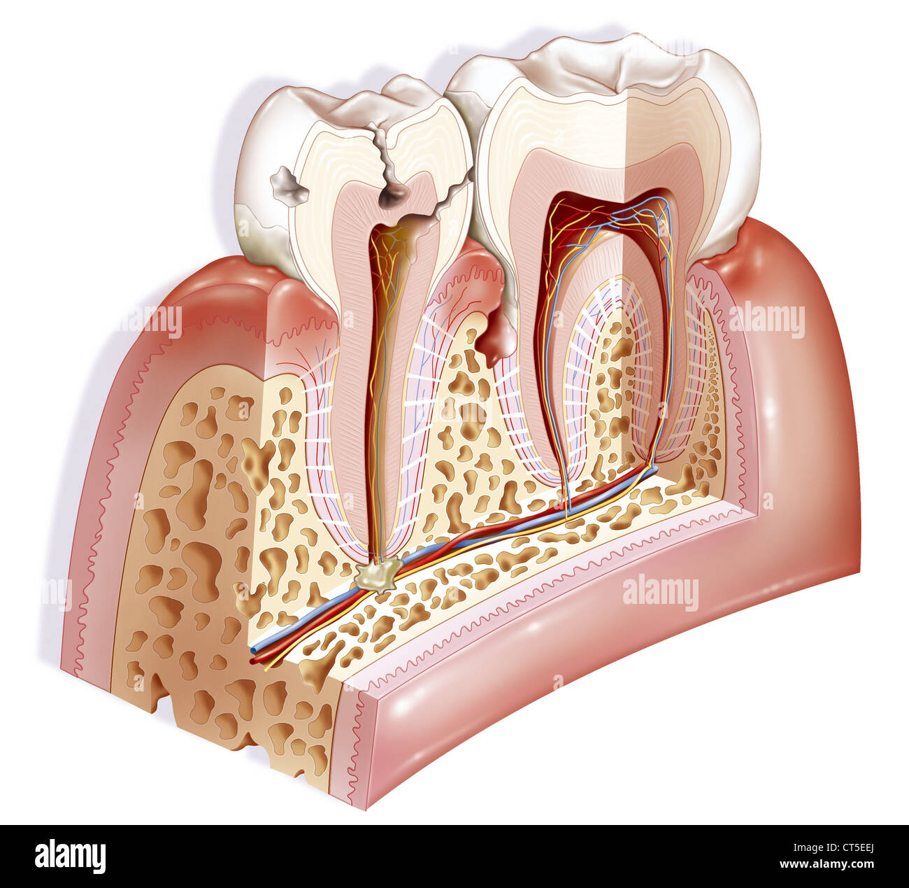 Patologia dentale, disegno Foto Stock