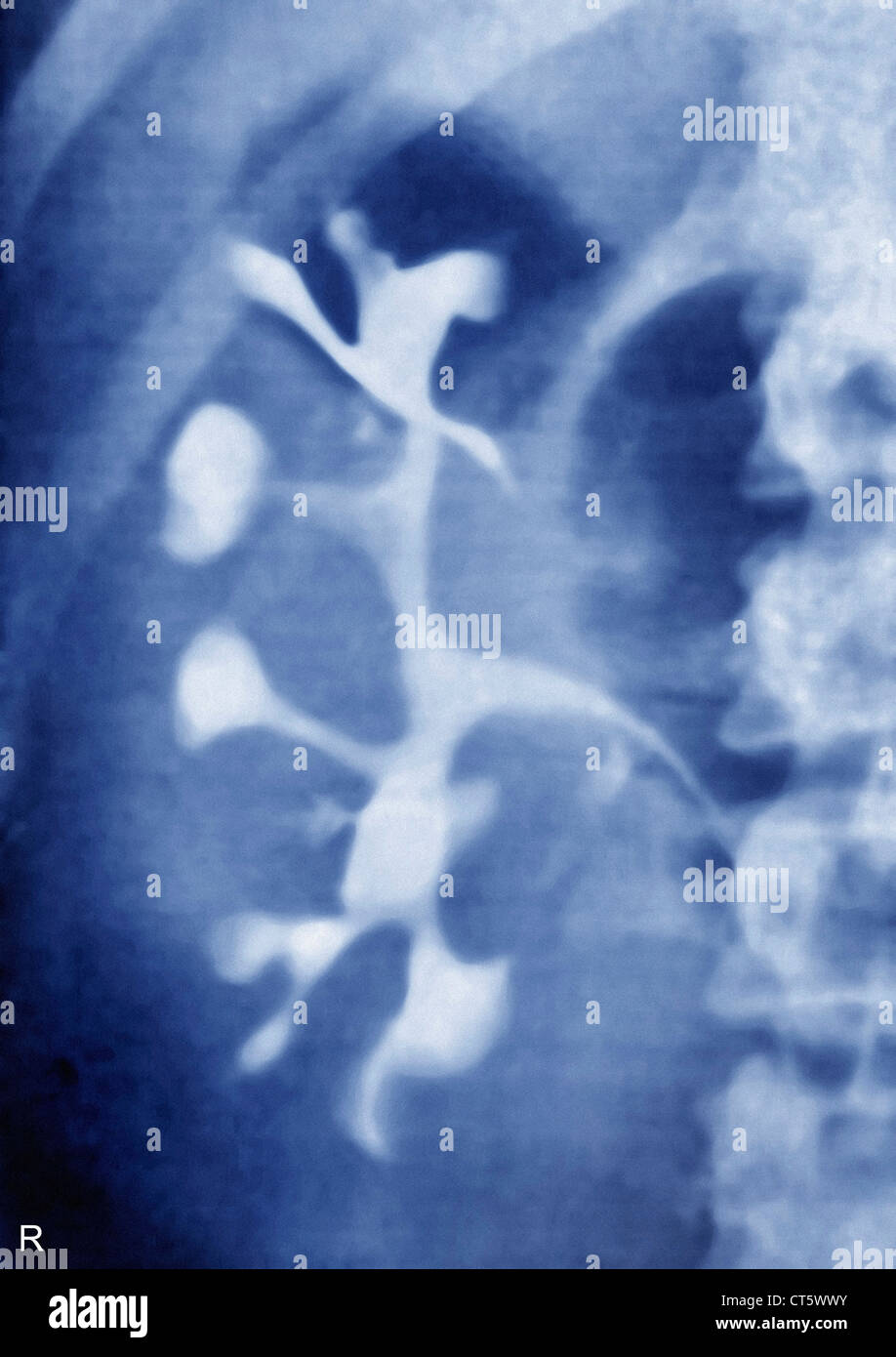 Rene Policistico, X-RAY Foto Stock