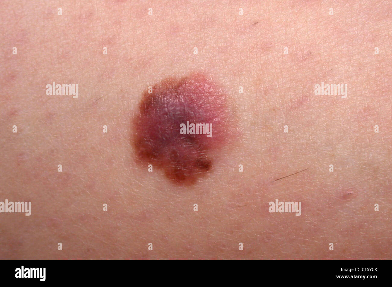 MELANOMA Foto Stock