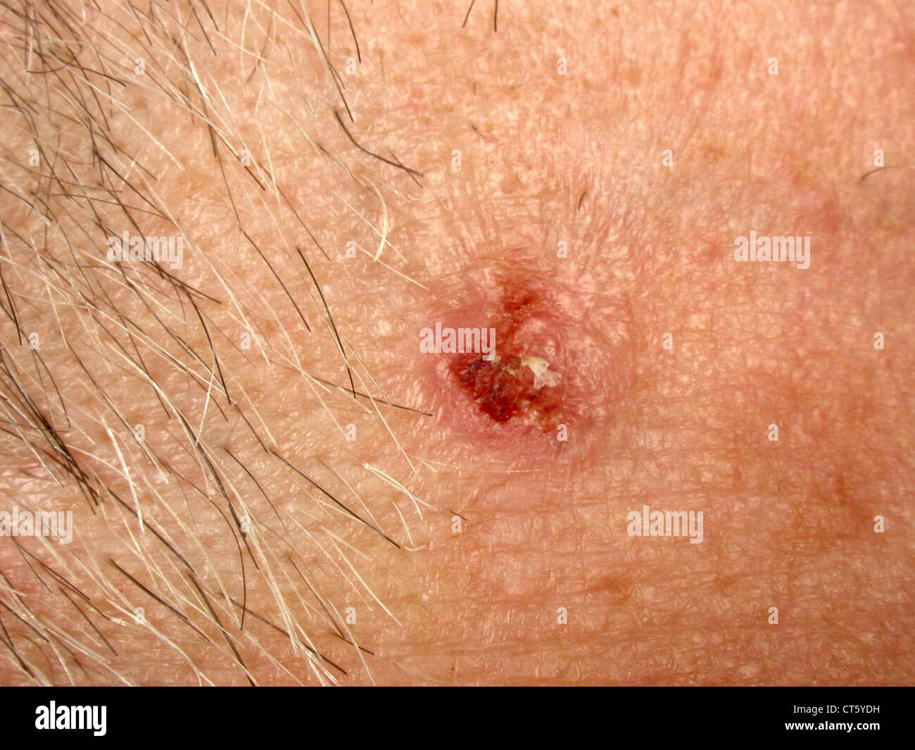 Il tumore maligno della pelle Foto Stock