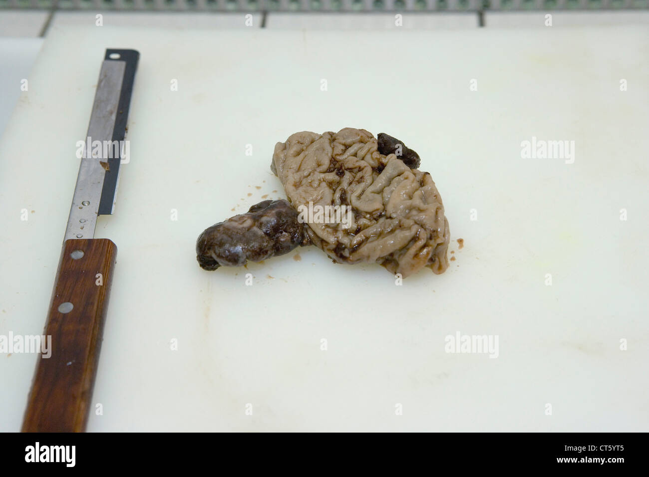 Patologia anatomica Foto Stock