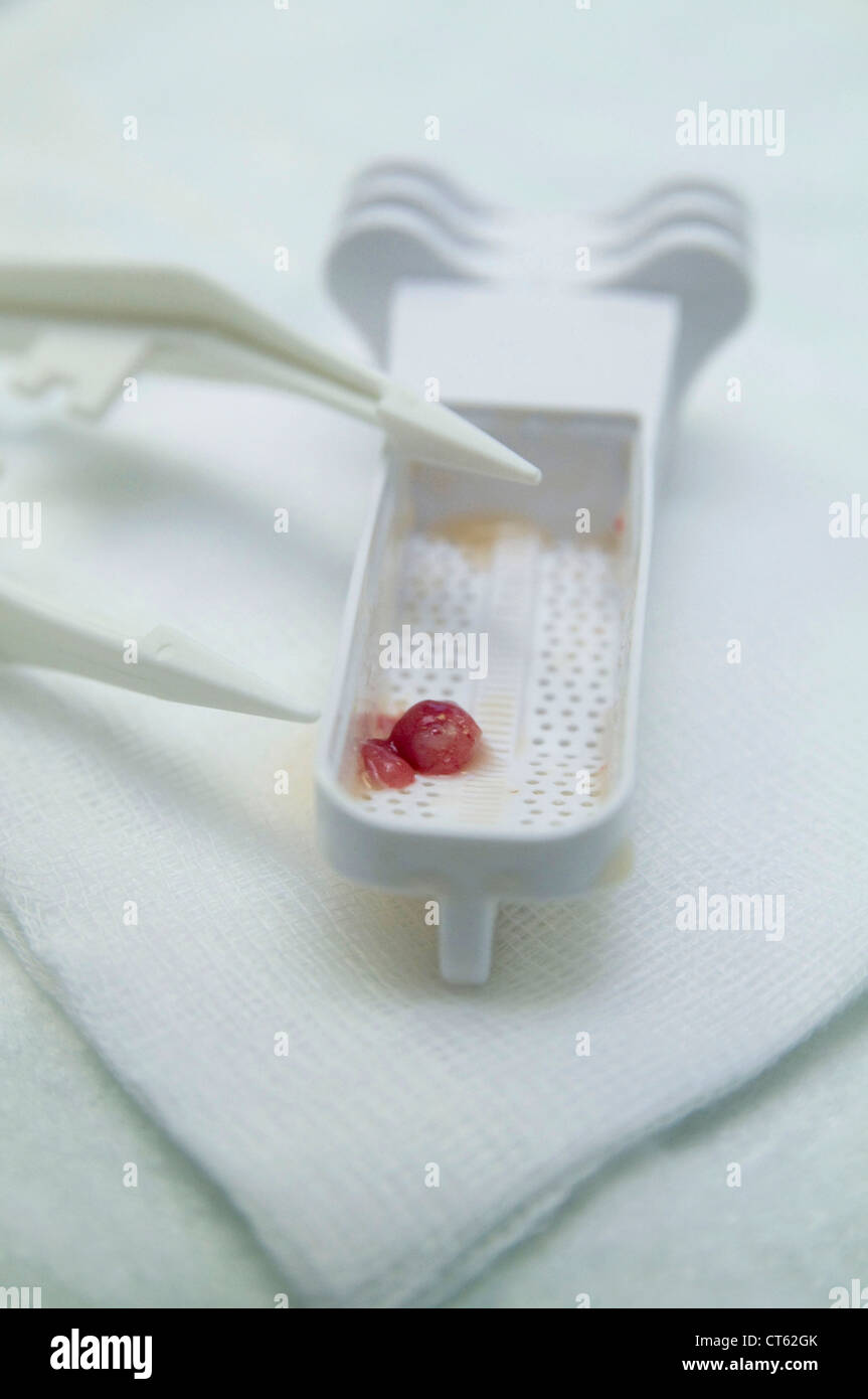 Polipo al colon, anatomia Foto Stock