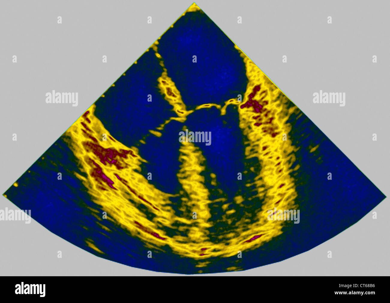 Cuore, ecografia risultato Foto Stock