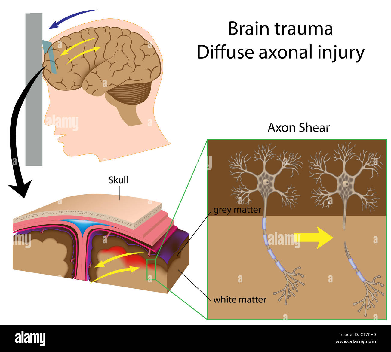 Trauma cerebrale con axon shear Foto Stock