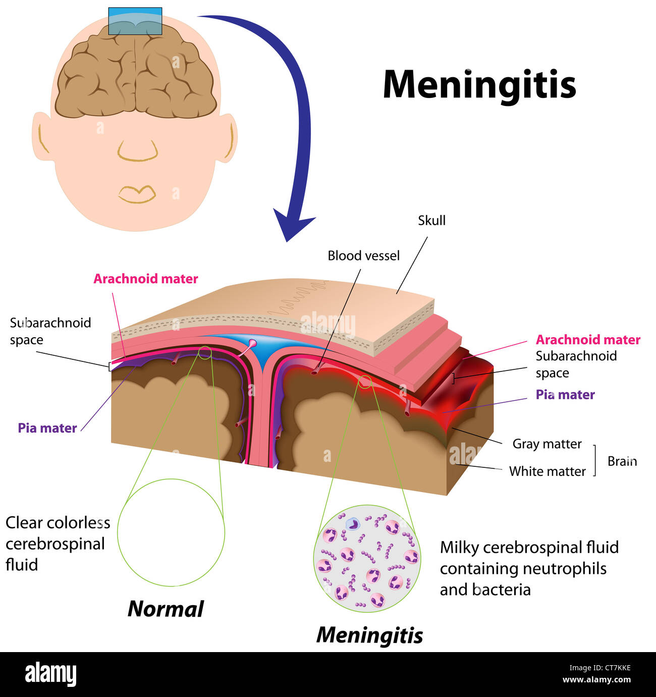 Meningite Foto Stock