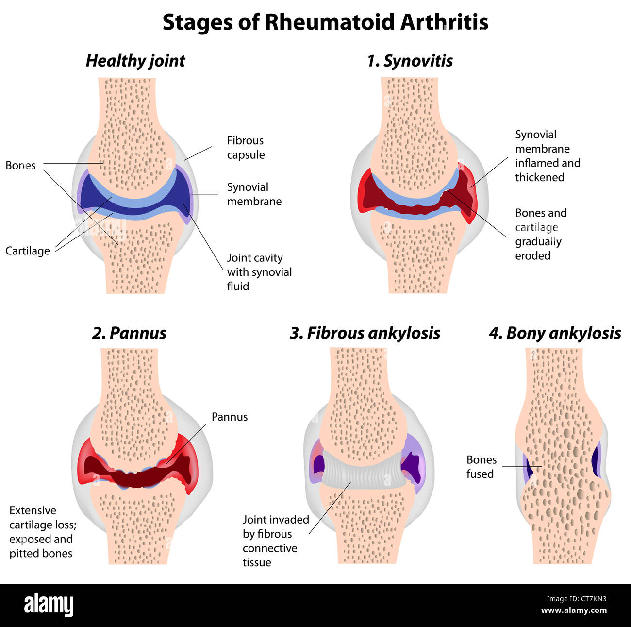 Fasi di artrite reumatoide Foto Stock