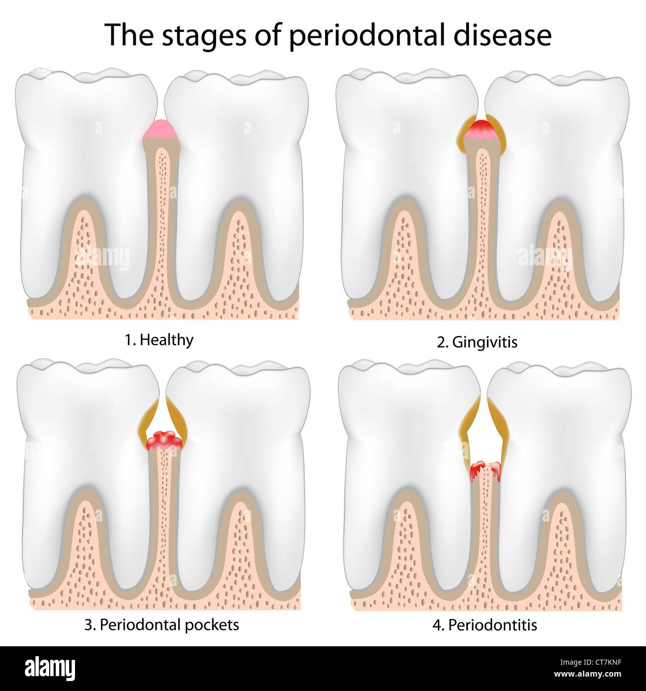 La malattia periodontale Foto Stock