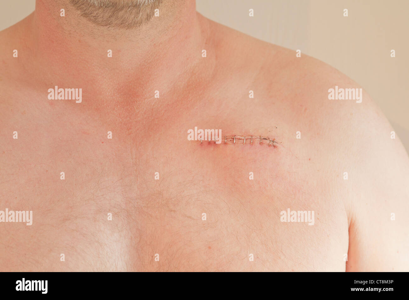 Pacemaker cicatrice su un maschio di 45 anni Foto Stock