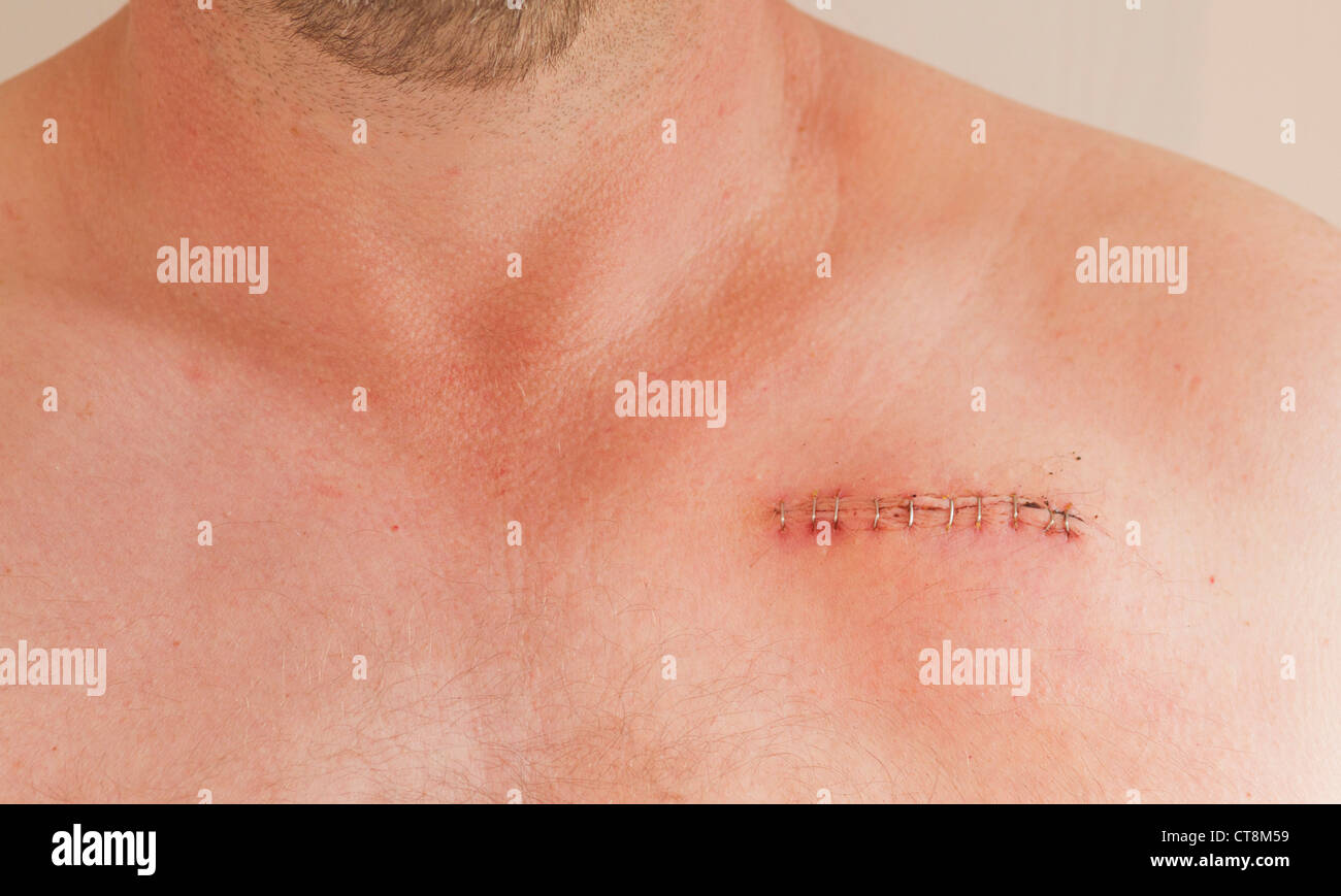 Pacemaker cicatrice su un maschio di 45 anni Foto Stock