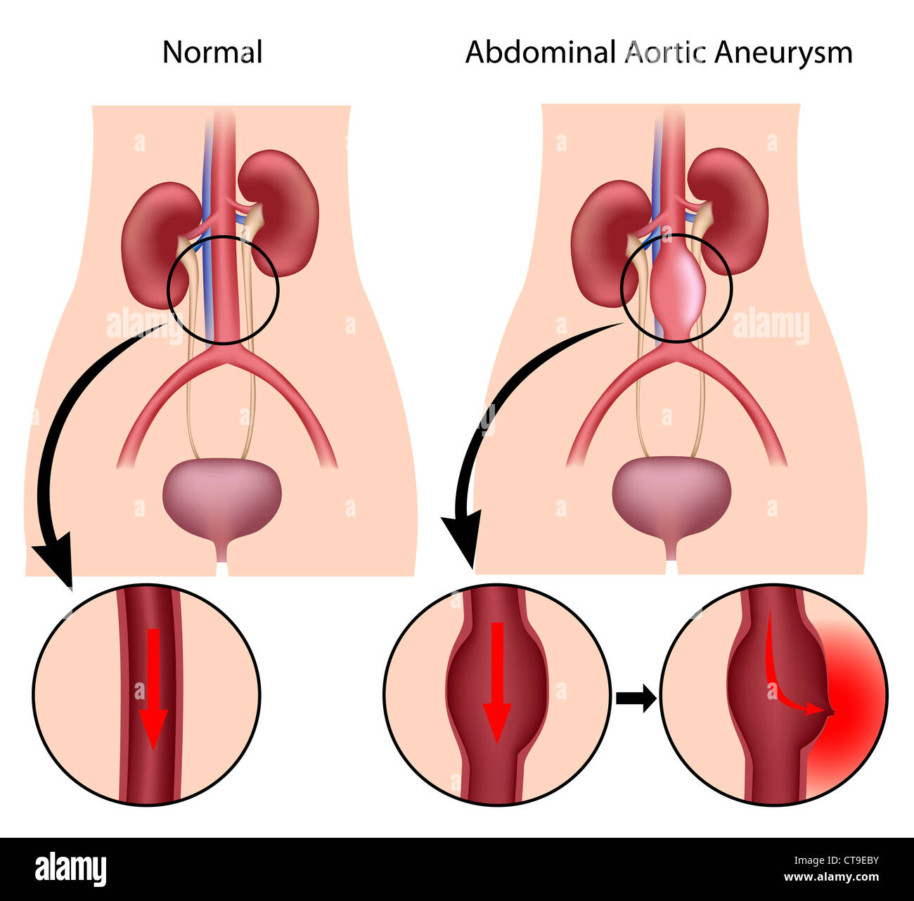 Aneurisma aortico addominale Foto Stock