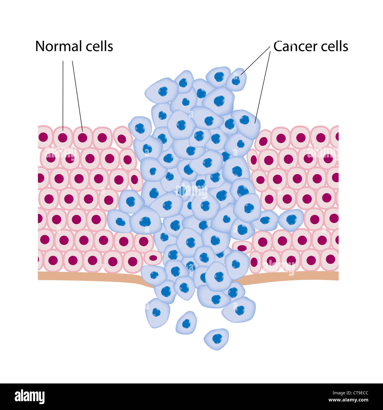 Le cellule del cancro in un tumore Foto Stock