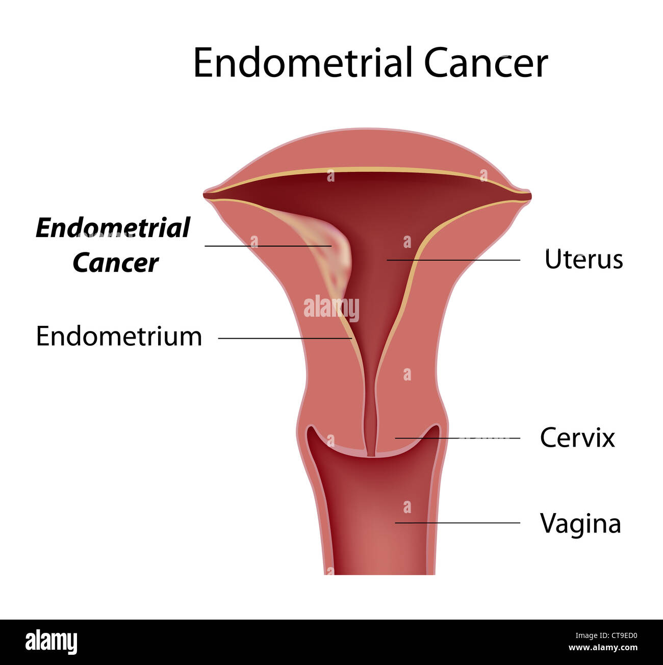 Cancro endometriale Foto Stock