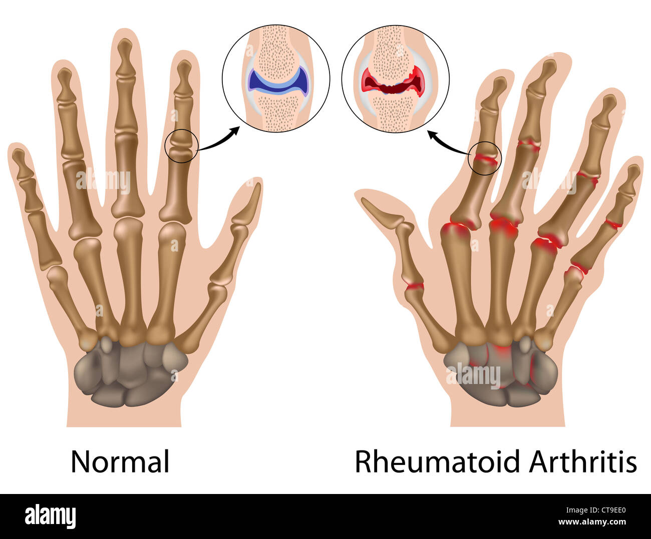 Artrite reumatoide della mano (finger-joint) Foto Stock
