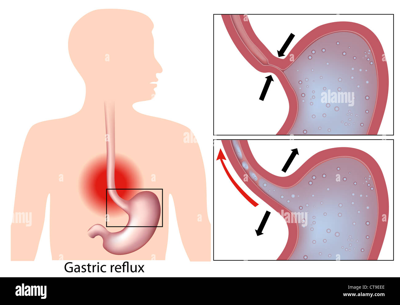 Bruciori di stomaco (stomaco reflusso acido) meccanismo Foto Stock