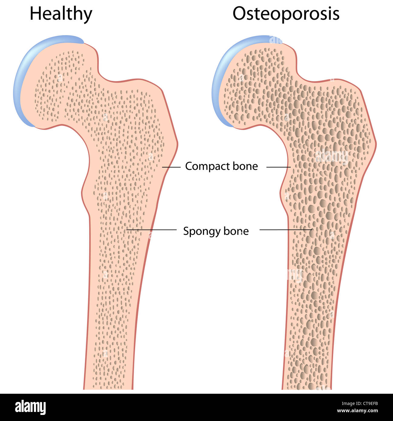 L'osteoporosi di osso dell'anca (femore) Foto Stock