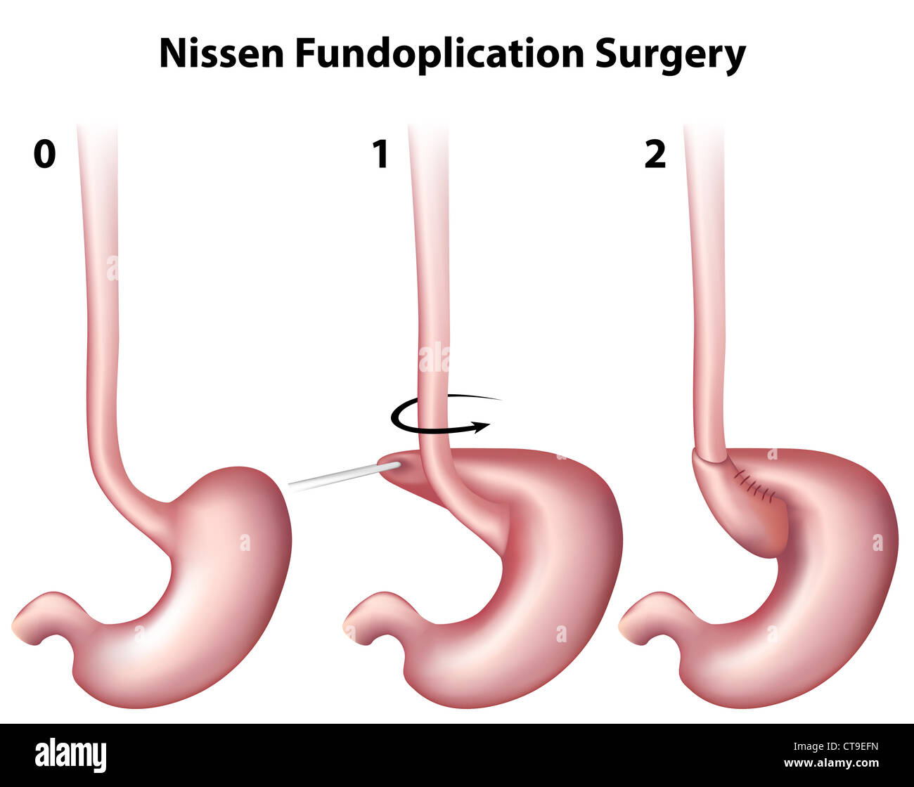 Nissen Fundoplication chirurgia Foto Stock