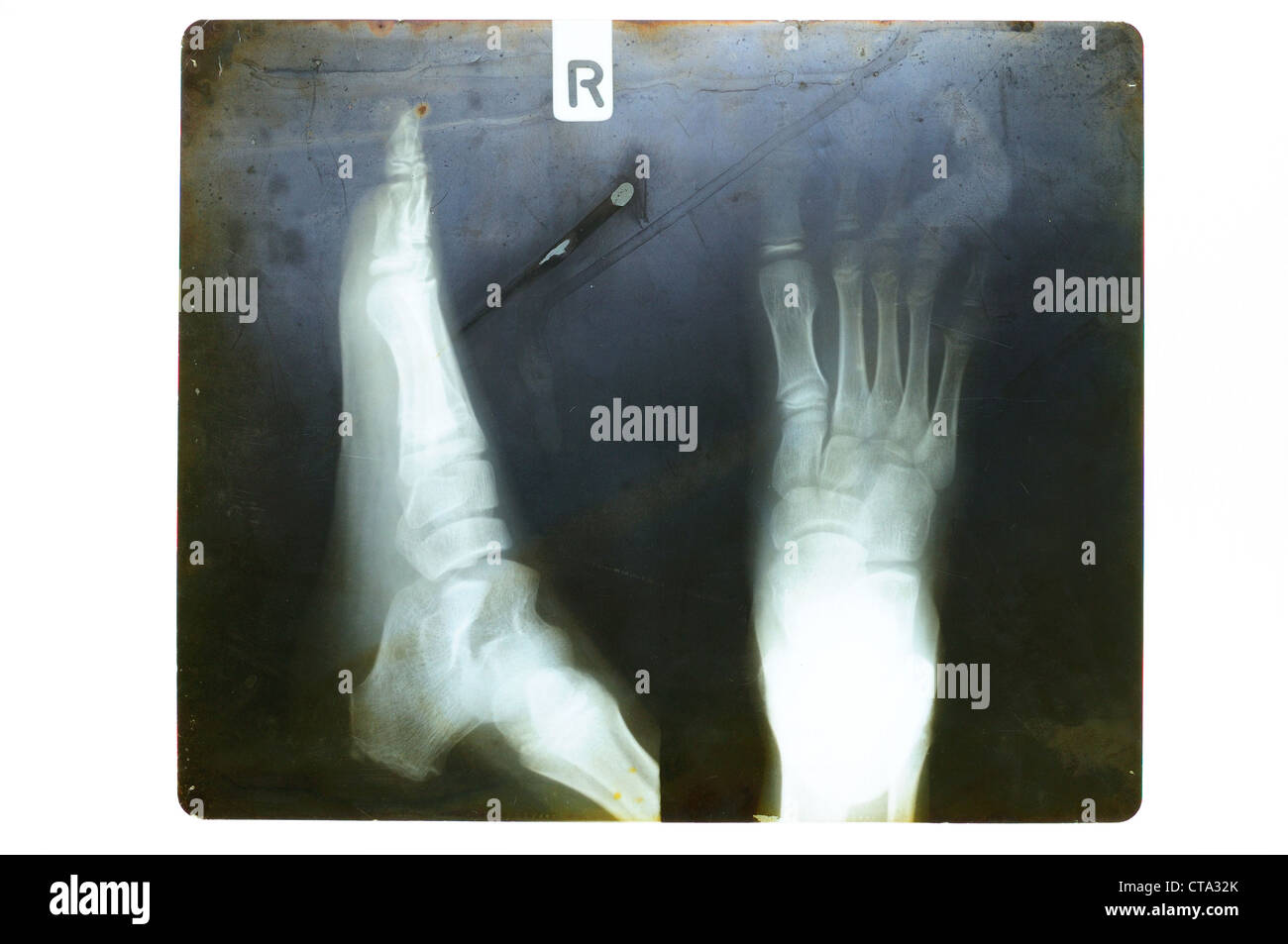 Vecchia pellicola a raggi x con vista laterale e dall'alto di destra piede di capretto Foto Stock