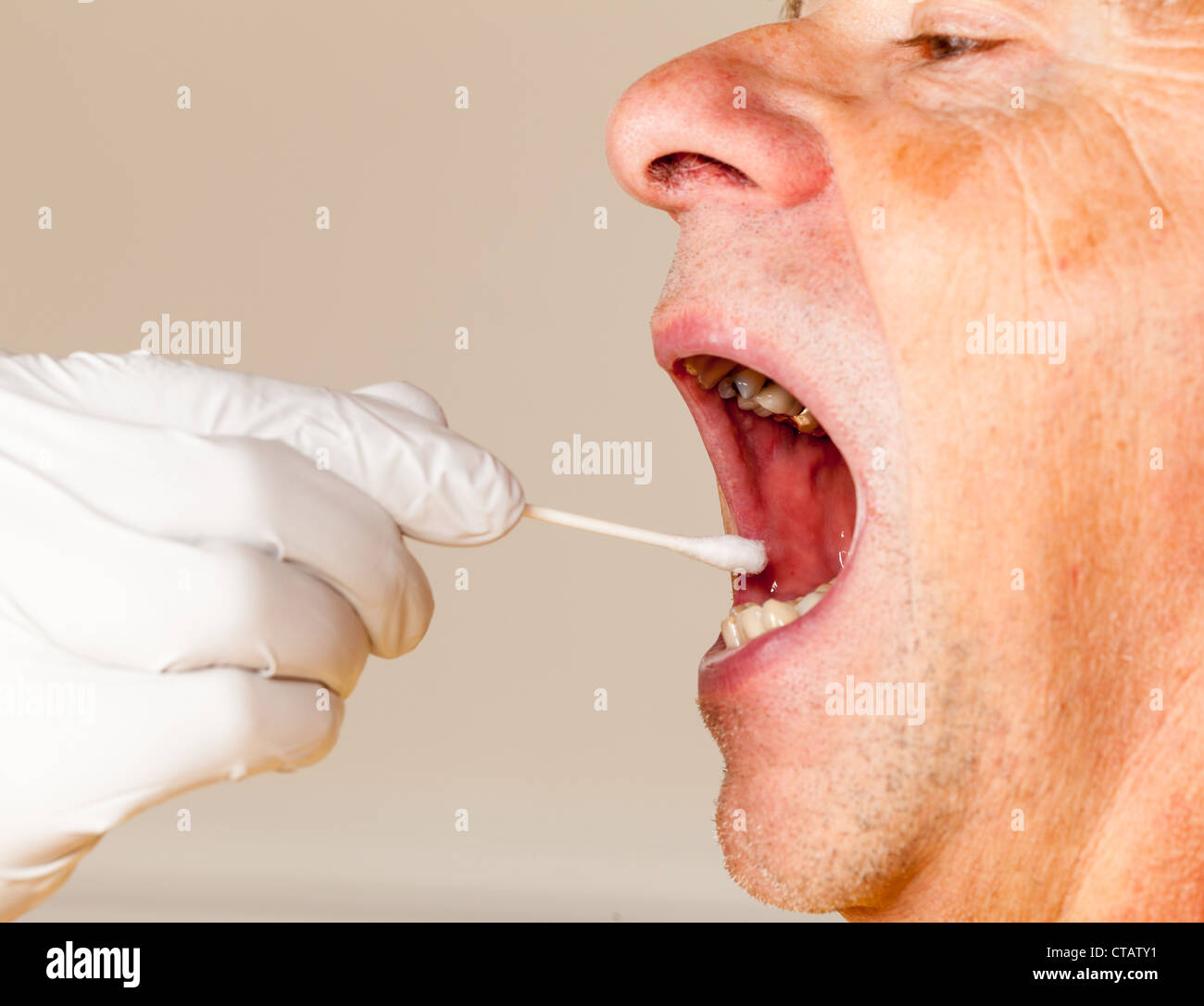 La mano guantata prendendo un fluido corporeo campione per il test del DNA dal senior persona maschio Foto Stock