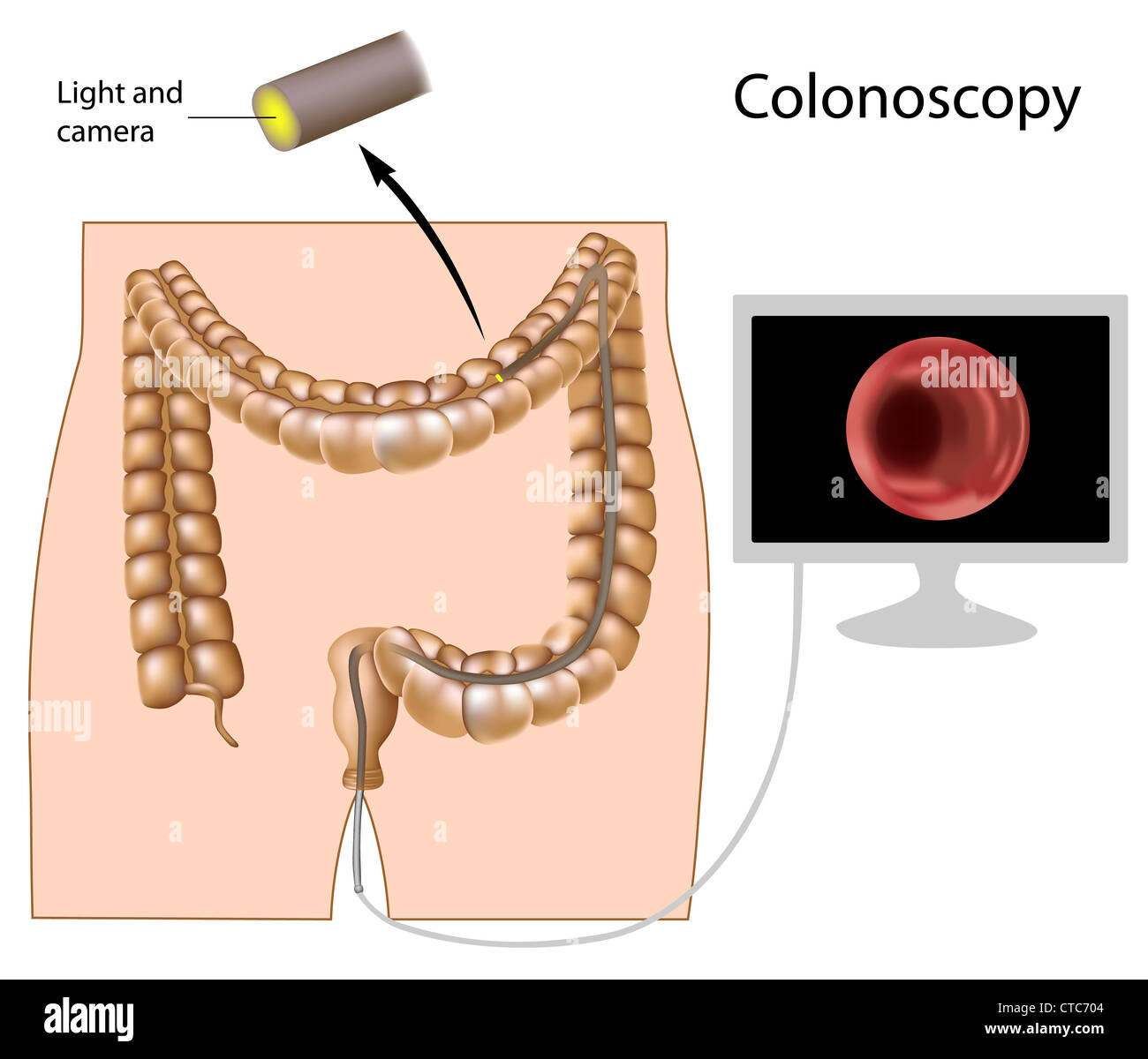 Colonoscopia procedura Foto Stock