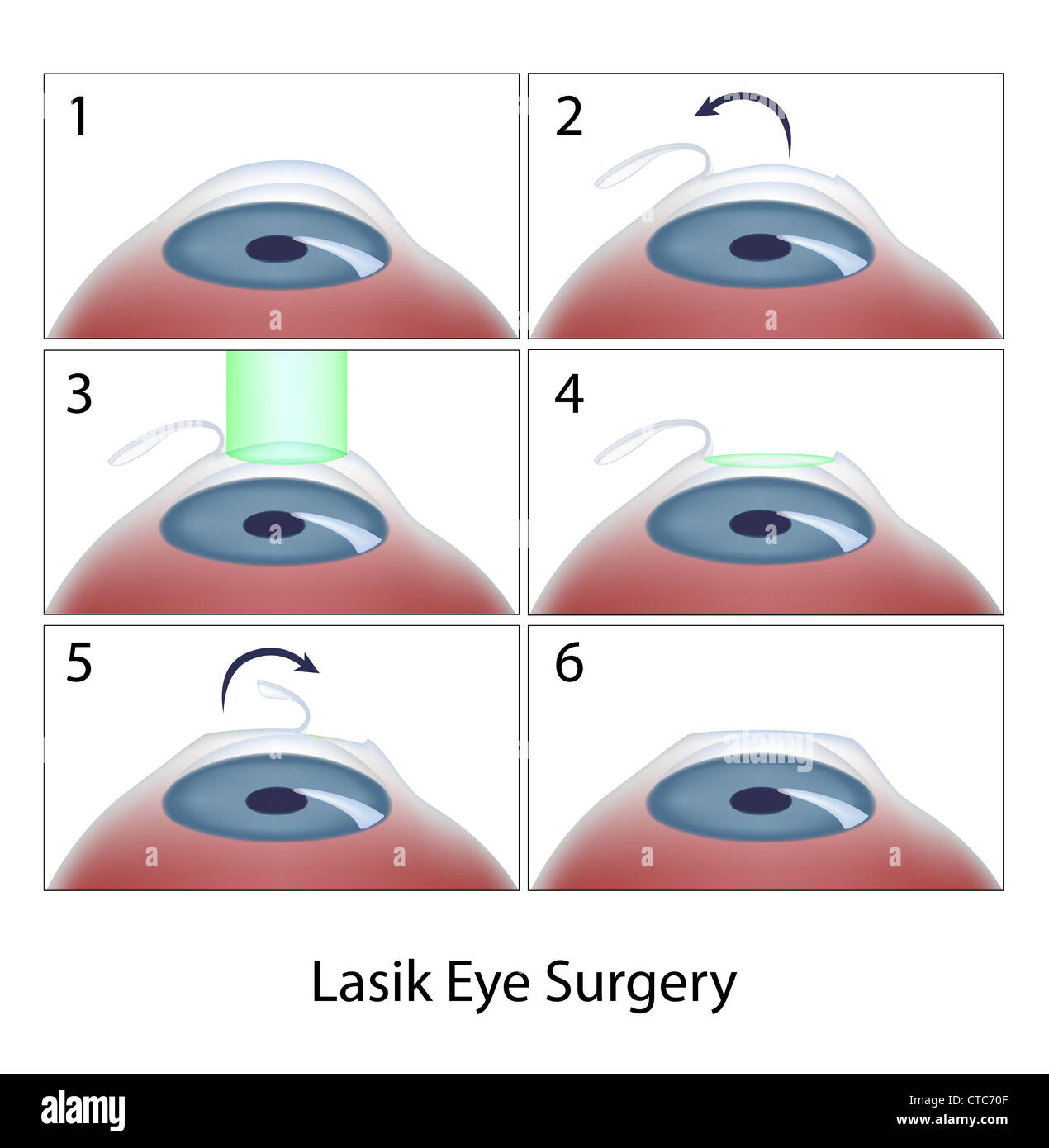 Lasik Eye Surgery procedura Foto Stock