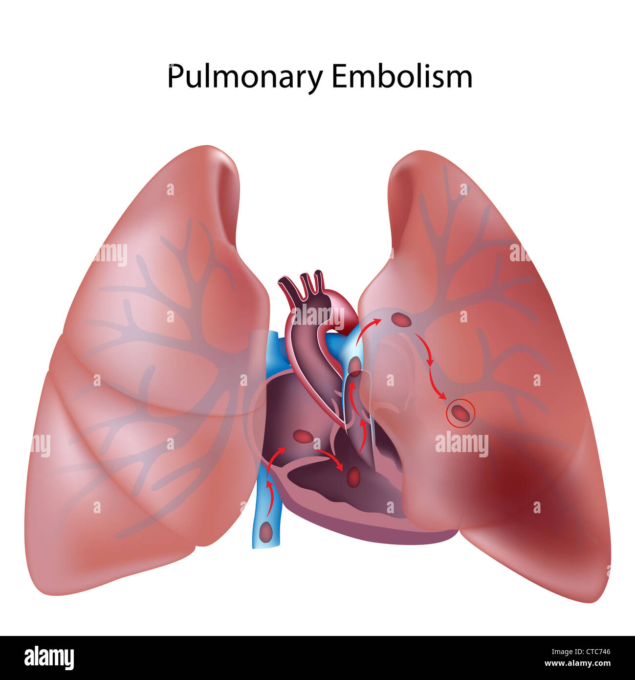 L'embolia polmonare Foto Stock