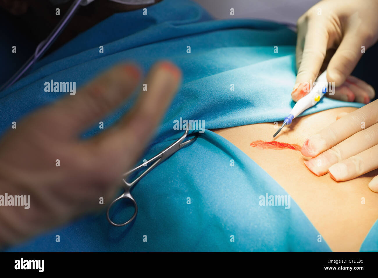 Medico usando un bisturi durante un intervento chirurgico Foto Stock