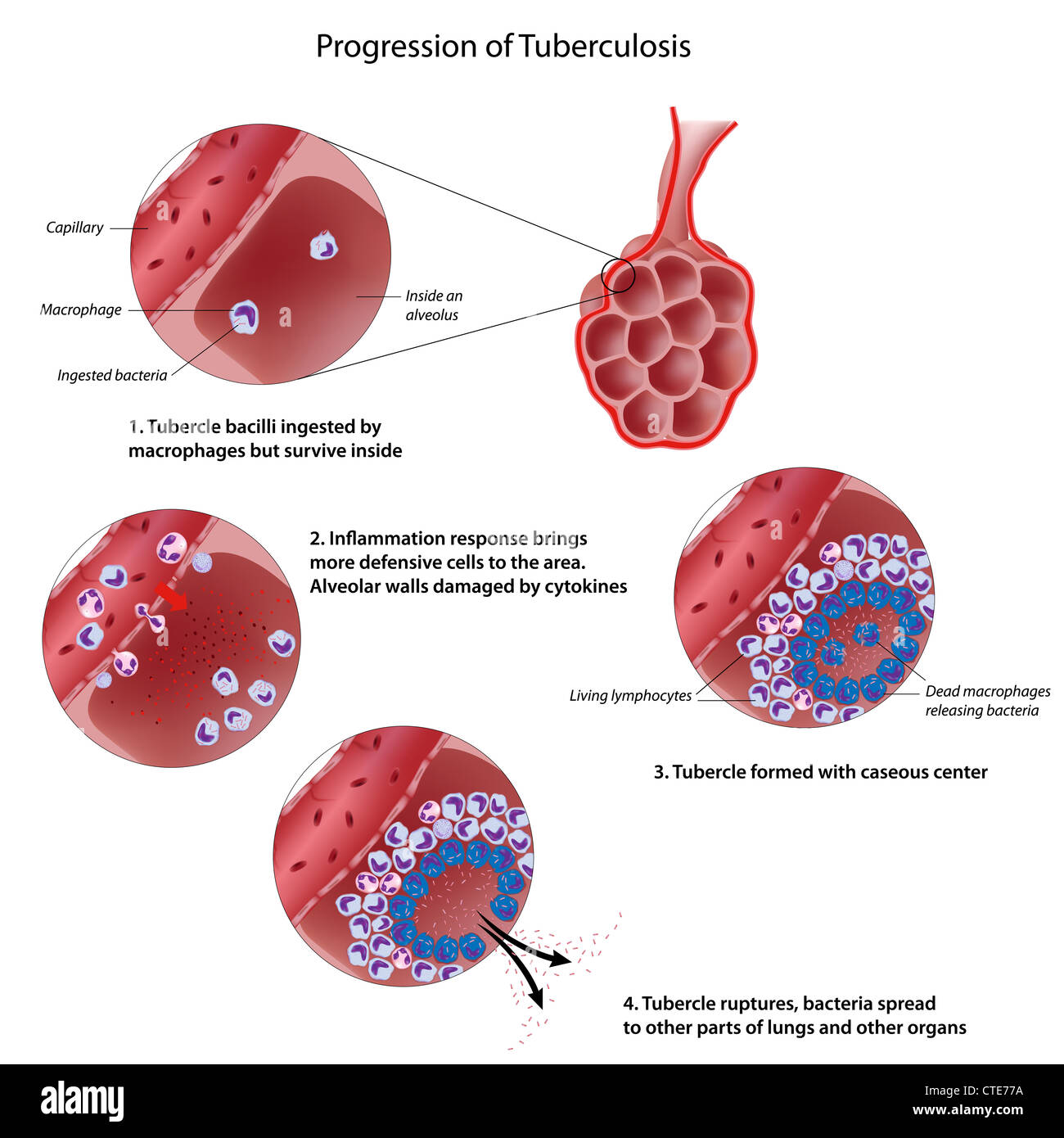 La progressione della tubercolosi polmonare Foto Stock