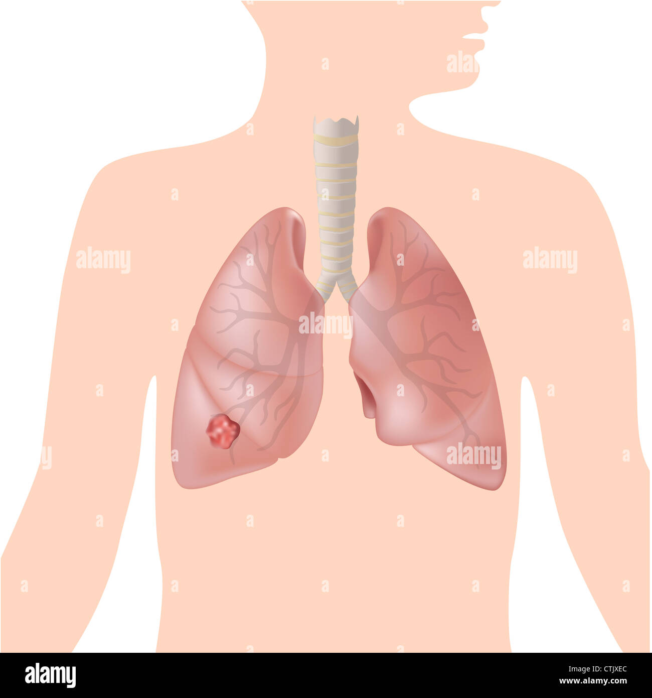 Cancro del polmone Foto Stock