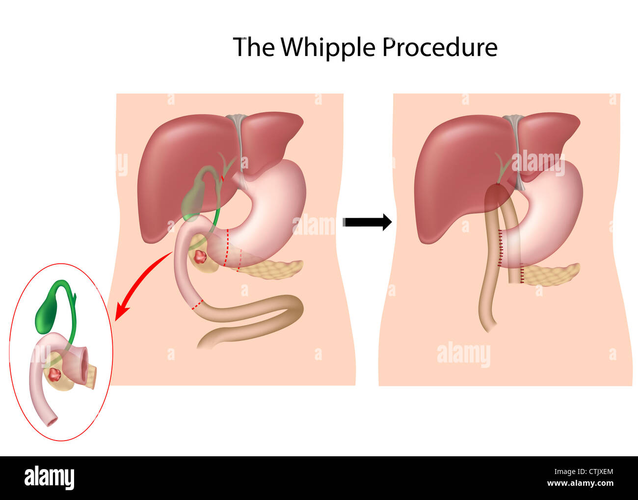 La procedura di Whipple per il trattamento del cancro nella parte di testa del pancreas Foto Stock