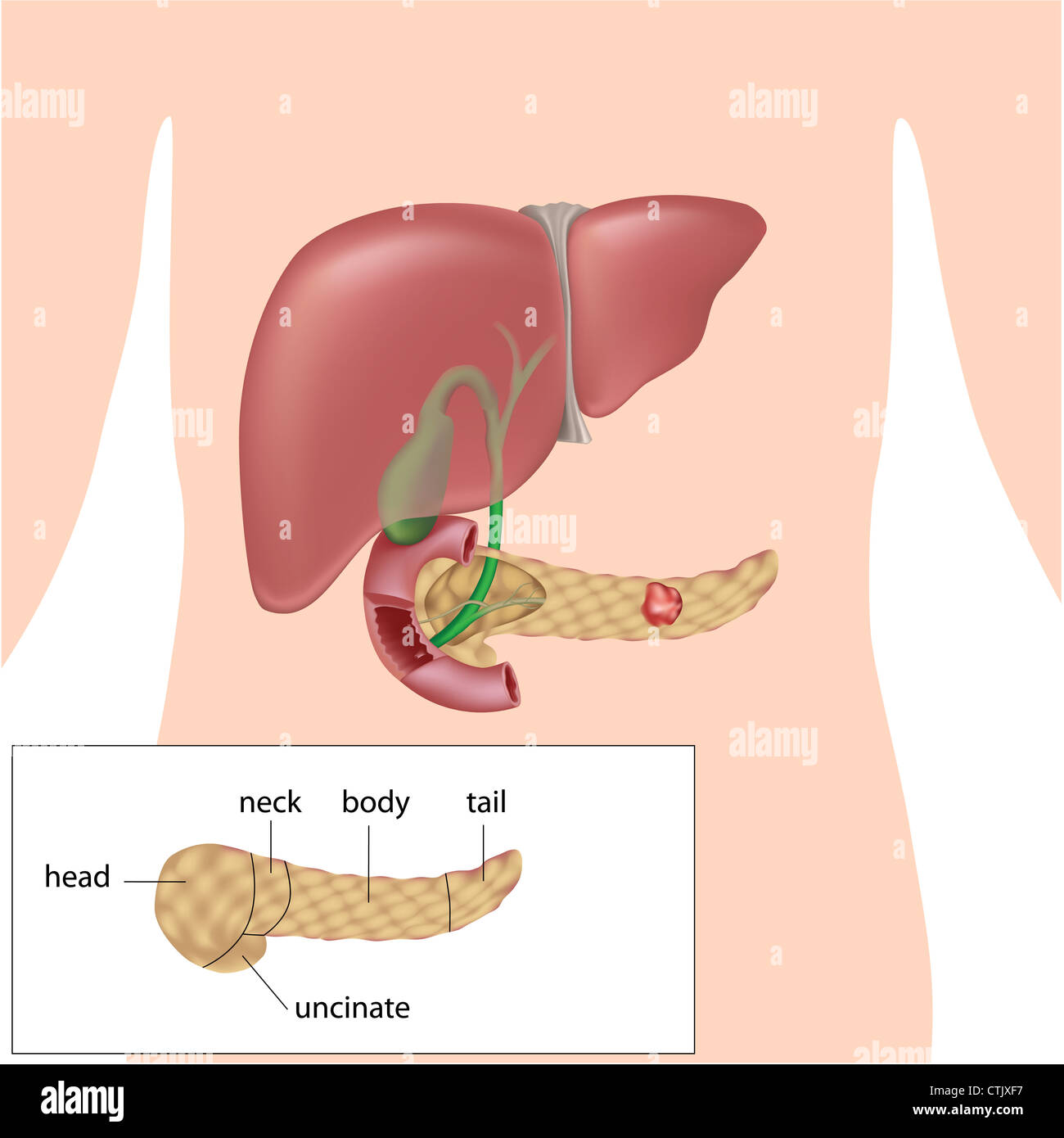 Il tumore al pancreas e schema di parti del pancreas Foto Stock
